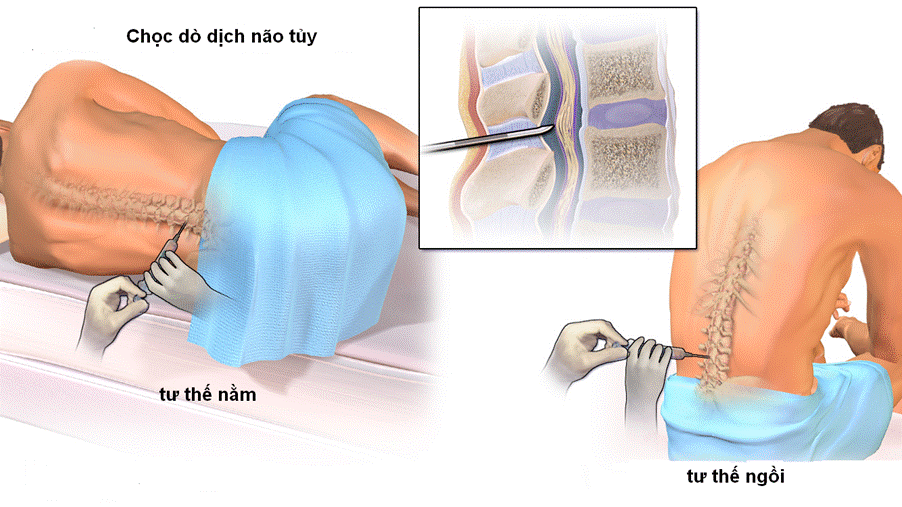 Viêm tủy cắt ngang: Nguyên nhân, triệu chứng và phương pháp điều trị 8