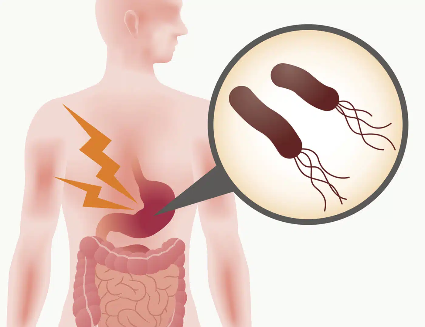 Nguyên nhân đau dạ dày cấp và cách xử trí 2