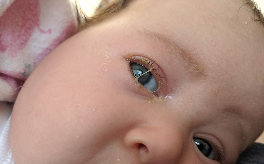 Trẻ sơ sinh đổ ghèn 1 bên mắt nguy hiểm không? Xử trí như thế nào?1